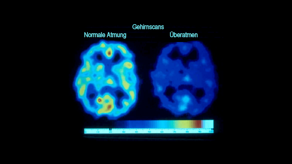 Gehirnscans zeigen die Reduzierung des Sauerstoffgehalts aufgrund von Überatmung