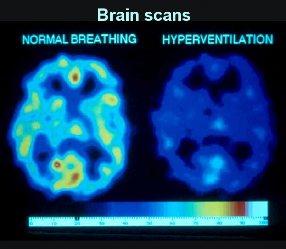 Brain scans showing oxygen depletion on voluntary over breathing